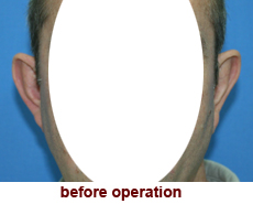 plastic-surgery-prominent-ear 